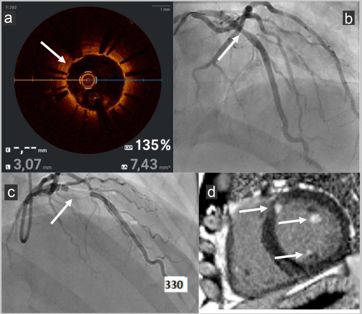Persistent Impairment of Coronary Microvascular Dysfunction After Percutaneous Coronary Intervention in an Ice Swimming Champion.
