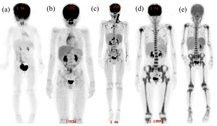 Unique Bone Marrow Findings of FDG-PET/CT in Acute Leukemia in Children: Comparison to Inflammatory Diseases.