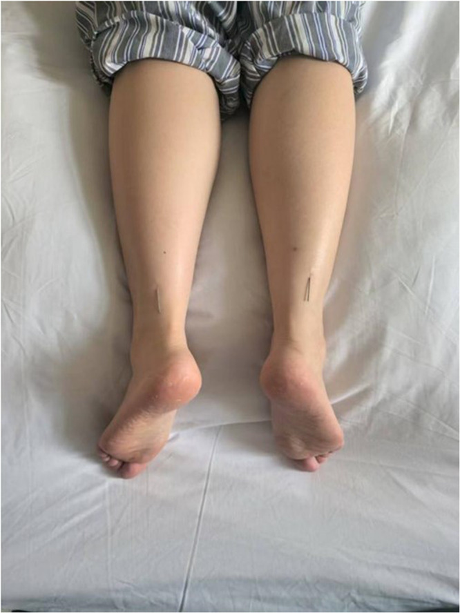 Wrist-Ankle Acupuncture Relieves Postoperative Pain After Milligan-Morgan Hemorrhoidectomy for Mixed Hemorrhoids: A Randomized Controlled Clinical Trial.
