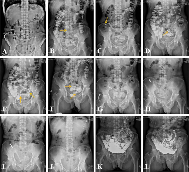 A novel approach of manual manipulation of the transnasal ileus tube for severe or recurrent benign adhesive small bowel obstruction.