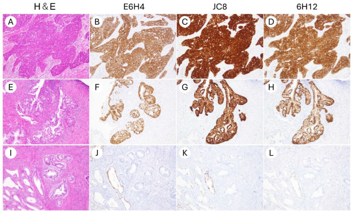 Comparative Evaluation of Three Primary Antibody Clones for p16 Immunohistochemistry in Gynecologic Tumors.