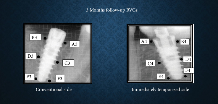 Comparison of Bone Density and Crestal Bone Loss Between Immediately Temporized and Submerged Implants in the Posterior Mandible: A Radiovisiographic Study.