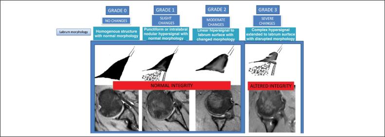 SHORT-TERM MRI EVALUATION OF CAPSULOLABRAL REPAIR IN ATHLETES WITH ANTERIOR GLENOHUMERAL INSTABILITY: CORRELATION WITH CLINICAL OUTCOMES.