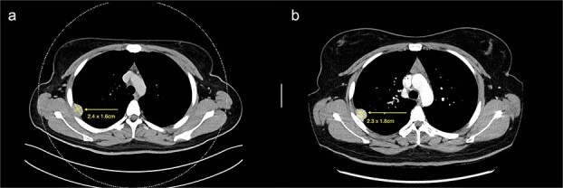A case of GLI1-altered mesenchymal pleural tumour with novel gene fusion: a clinical perspective.