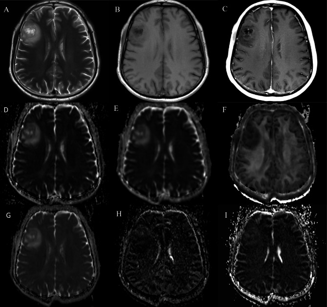 Whole-tumor histogram analysis of diffusion weighted imaging, diffusion kurtosis imaging, and intravoxel incoherent motion for adult diffuse glioma genotyping.