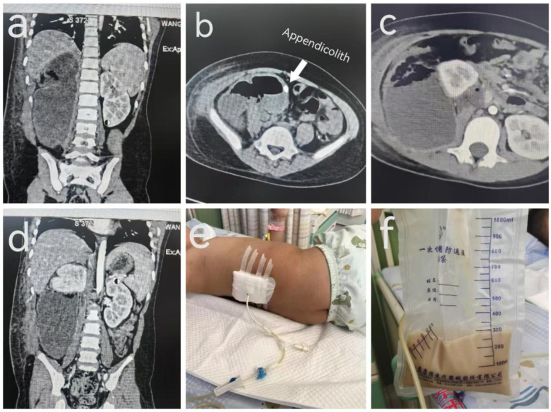 Renal compression caused by a giant retroperitoneal appendiceal abscess in a child: a rare case report and literature review.