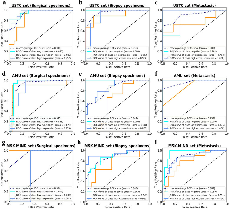 Artificial Intelligence-driven image analysis for standardised programmed death-ligand 1 expression evaluation in non-small cell lung cancer.