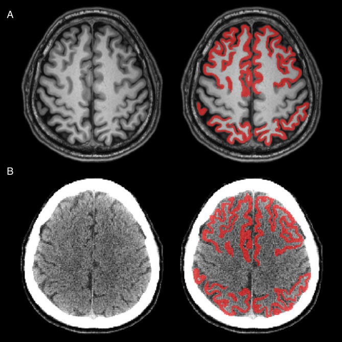 Centiloid values from deep learning-based CT parcellation: a valid alternative to freesurfer.