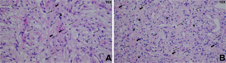 TERT promoter C250T mutation in a recurrent cervical chordoid meningioma: a unique case report.