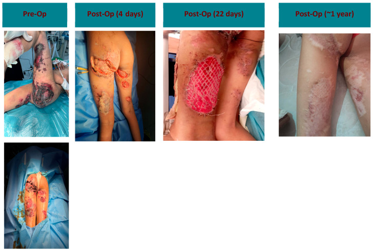 Utilization of a Multi-Tissue Extracellular Matrix in Complex Wound Care in Gaza: A Case Series.