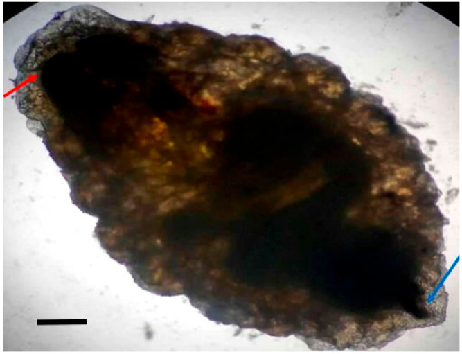 Nasal Myiasis Mimicking Allergic Rhinitis in Immunocompetent Adults: Case Series of 14 Adults.