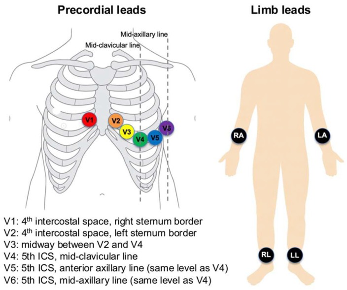 Sequential AI-ECG Diagnostic Protocol for Opportunistic Atrial Fibrillation Screening: A Retrospective Single-Center Study.
