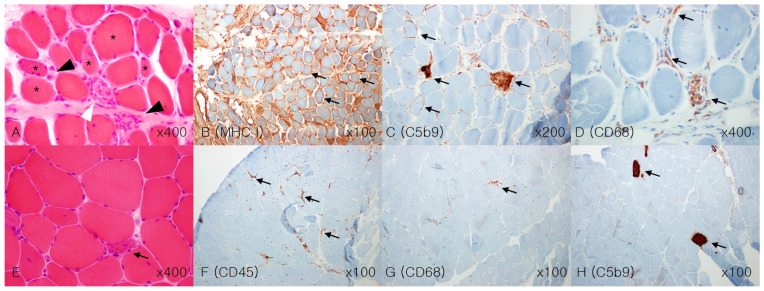 Clinical Characteristics and Management of Statin-Associated Anti-3-Hydroxy-3-Methylglutaryl-Coenzyme A Reductase Immune-Mediated Necrotizing Myopathy.