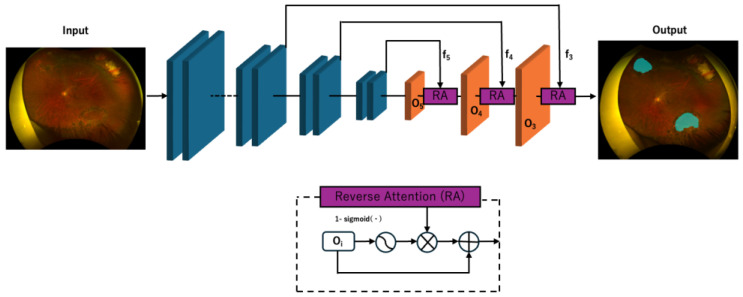 Pixel-Level Segmentation of Retinal Breaks in Ultra-Widefield Fundus Images with a PraNet-Based Machine Learning Model.