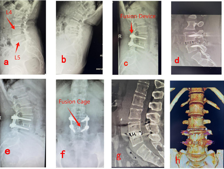 Comparison of clinical efficacy of two approaches for endoscopic lumbar fusion surgery in the treatment of single-segment lumbar spondylolisthesis.