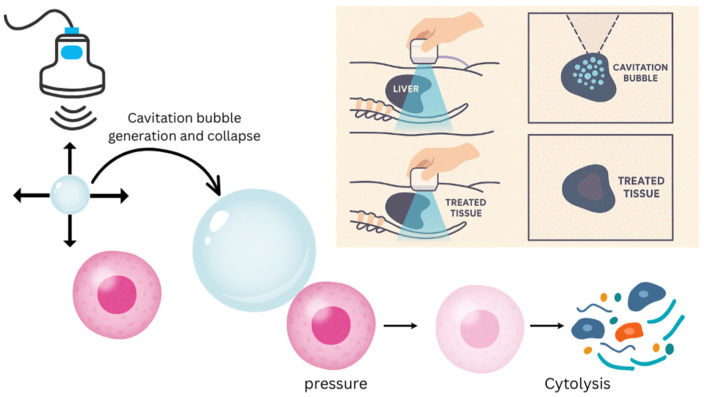Histotripsy: Recent Advances, Clinical Applications, and Future Prospects.