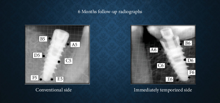 Comparison of Bone Density and Crestal Bone Loss Between Immediately Temporized and Submerged Implants in the Posterior Mandible: A Radiovisiographic Study.