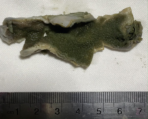 Actinomycosis of the Gallbladder in a Young Diabetic Woman with Acute Lithiasis Cholecystitis: A Case Report and Review of the Literature.