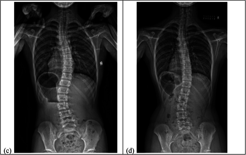 How the curve morphology differs between curve types in patients with adolescent idiopathic scoliosis during brace treatment?