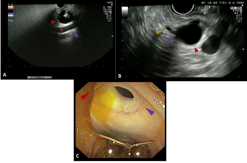Endoscopic ultrasound for pancreatic cystic lesions: a narrative review.