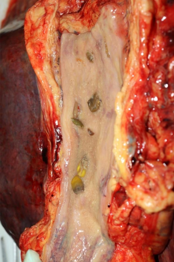 Lack of gastric emptying at autopsy eleven days after heat trauma in the sauna- a forensic autopsy case report.