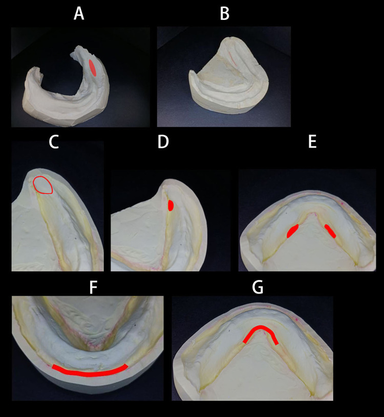 Analysis of Modification Zones in Mandibular Complete Denture Models Designed with the Bio-Functional Prosthetic System.