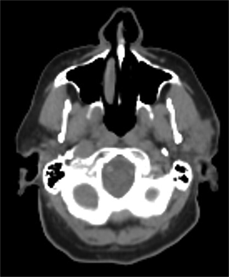 Genomic profiling guided therapy for synchronous SCC and CLL of the parotid gland: a rare case report.