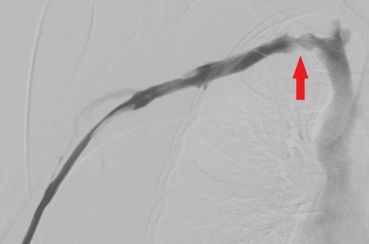 An Unusual Presentation of Paget-Schroetter Syndrome: A Reminder on the Importance of Clinical Judgment.