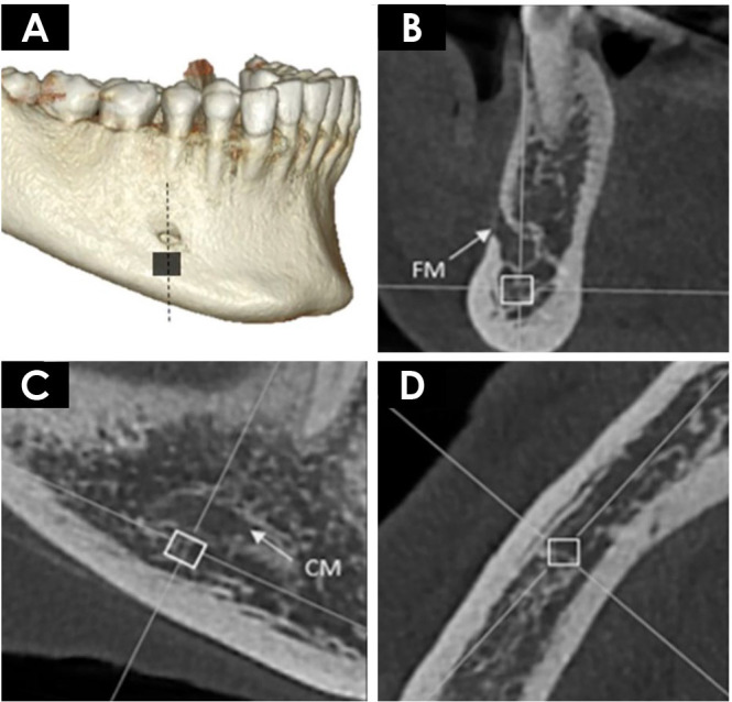 Influence of cone-beam computed tomography reconstruction parameters on bone fractal dimension: A cross-sectional observational study.