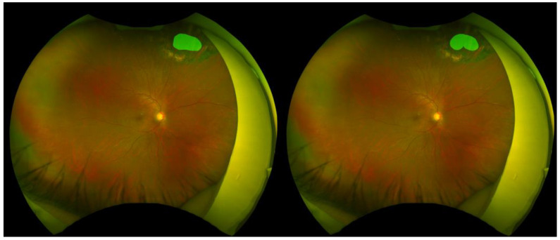 Pixel-Level Segmentation of Retinal Breaks in Ultra-Widefield Fundus Images with a PraNet-Based Machine Learning Model.