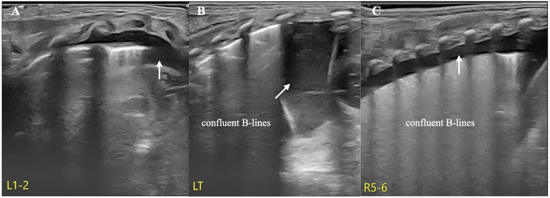 Case Report: Air-fluid point: a specific ultrasound sign for the diagnosis of hydropneumothorax in newborn infants.
