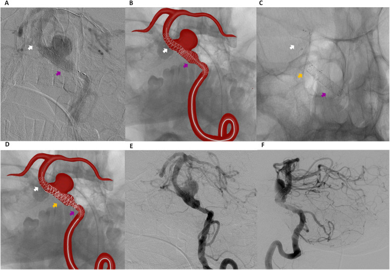 Case Report: "Stent-within-a-Stent" technique after telescopic flow diverter reconstruction for basilar artery aneurysm with proximal stenosis.