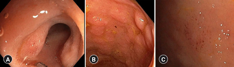 Endoscopic assessment of terminal ileum in screening colonoscopy: is it worth the effort?