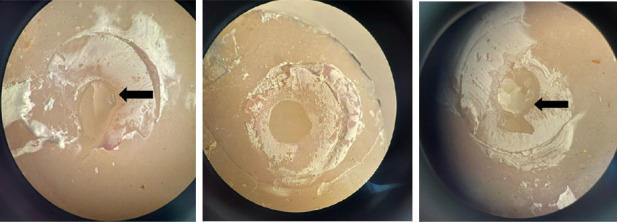 Degree of Conversion and Microshear Bond Strength of New Composite to Postcured Composite Resin Surface Treated With Ethyl Acetate.