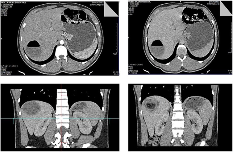 Laparoscopic management of a Gharbi type II hepatic hydatid cyst after failed pair.