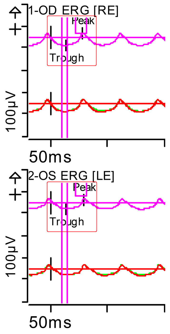 Nyctalopia Due to Vitamin A Deficiency Secondary to Short Bowel Syndrome: When the Electroretinogram Is the Diagnostic Key.