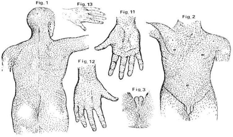 Melanoma Clues Beyond Dermoscopic Patterns: Lesion Orientation to Langer's Lines as a Predictor on the Trunk.
