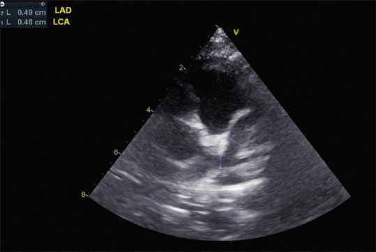 Echocardiographic Evaluation in Kawasaki Disease.