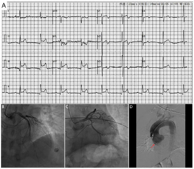 When the culprit lies outside the coronary artery: dual case report of coronary sinus of valsalva dissection presenting as STEMI.