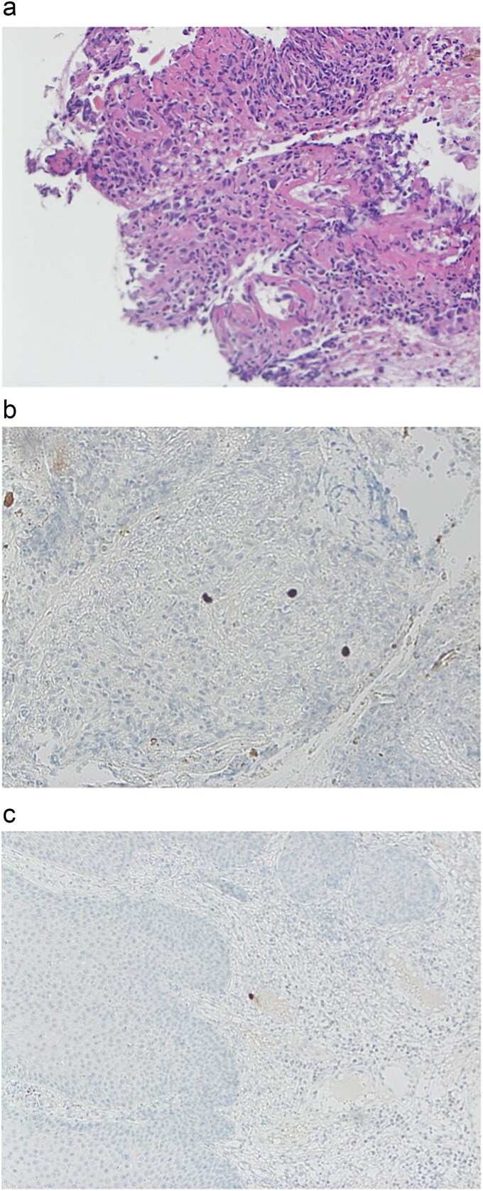 Late human immunodeficiency virus presenting as necrotizing anal ulceration due to cytomegalovirus.