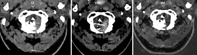 In Vivo Discrimination of Iodine and Tantalum-Based Liquid Embolics After Intracranial or Spinal Embolization Using Photon-Counting Detector CT.