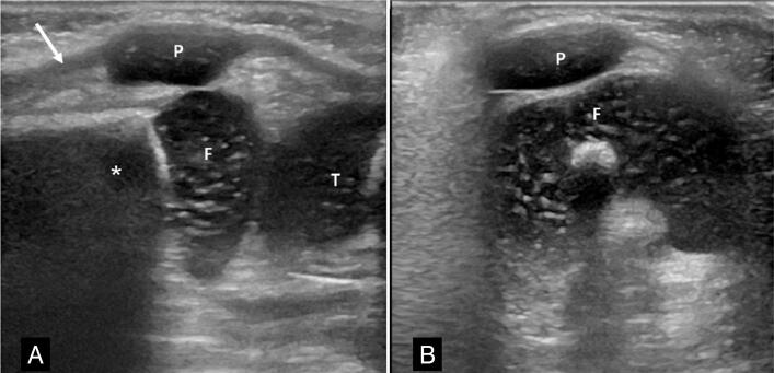 ULTRASONOGRAPHY OF THE CARTILAGINOUS PATELLA IN PEDIATRIC PATIENTS: A CASE SERIES.