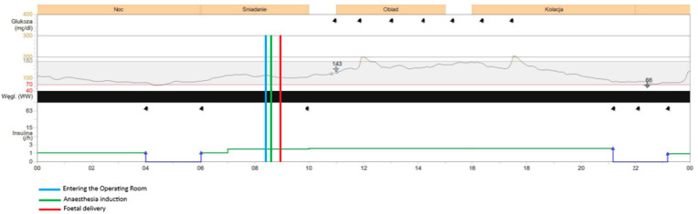 Optimizing Perioperative Glycaemic Control with Continuous Glucose Monitoring in Pregestational Diabetes: Feasibility and Comparative Analysis of Two Systems: A Pilot Study.