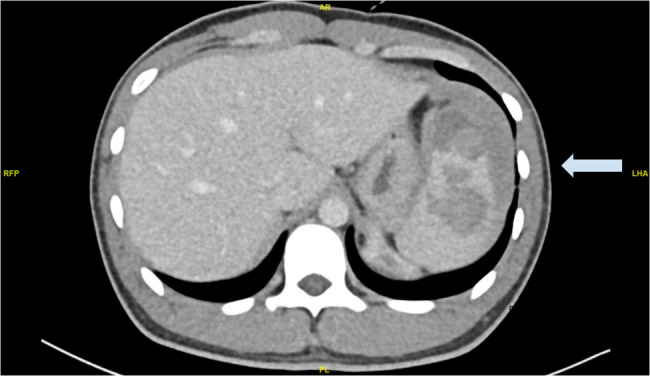 A unique case of atraumatic splenic haematoma likely caused by increased intra-abdominal pressure: a case report.