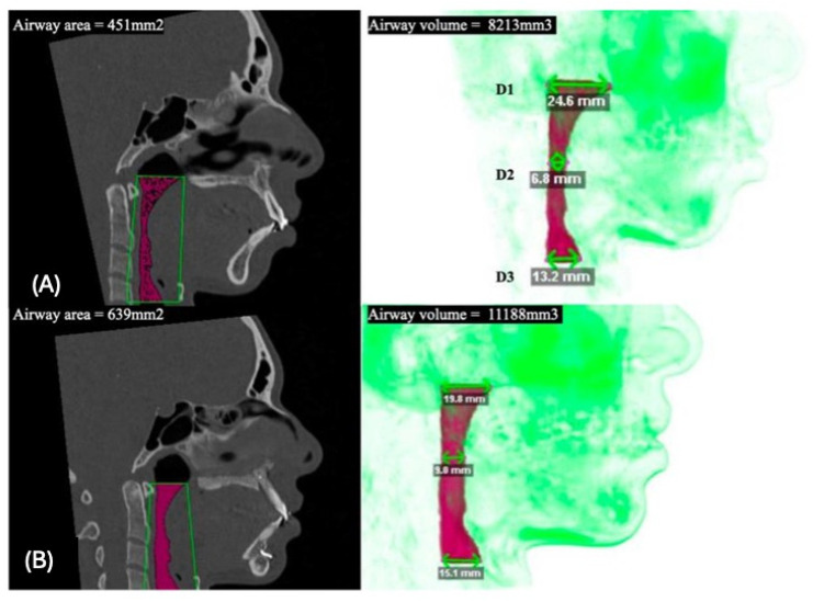 Evaluation of the Upper Airway in Class II Patients Undergoing Maxillary Setback and Counterclockwise Rotation in Orthognatic Surgery.