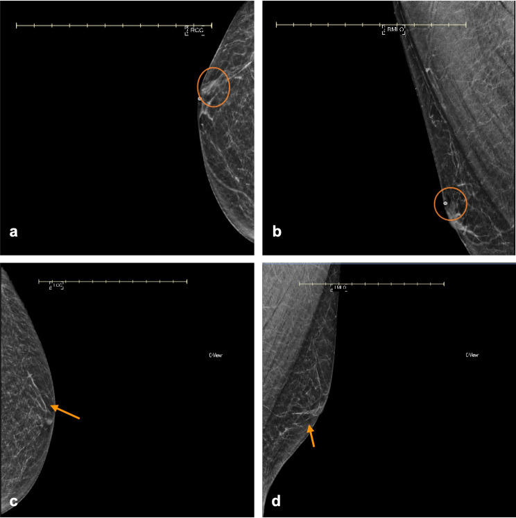 A rare incidence of pseudoangiomatous stromal hyperplasia (PASH) in a senior adult male: a case report highlighting a novel presentation.