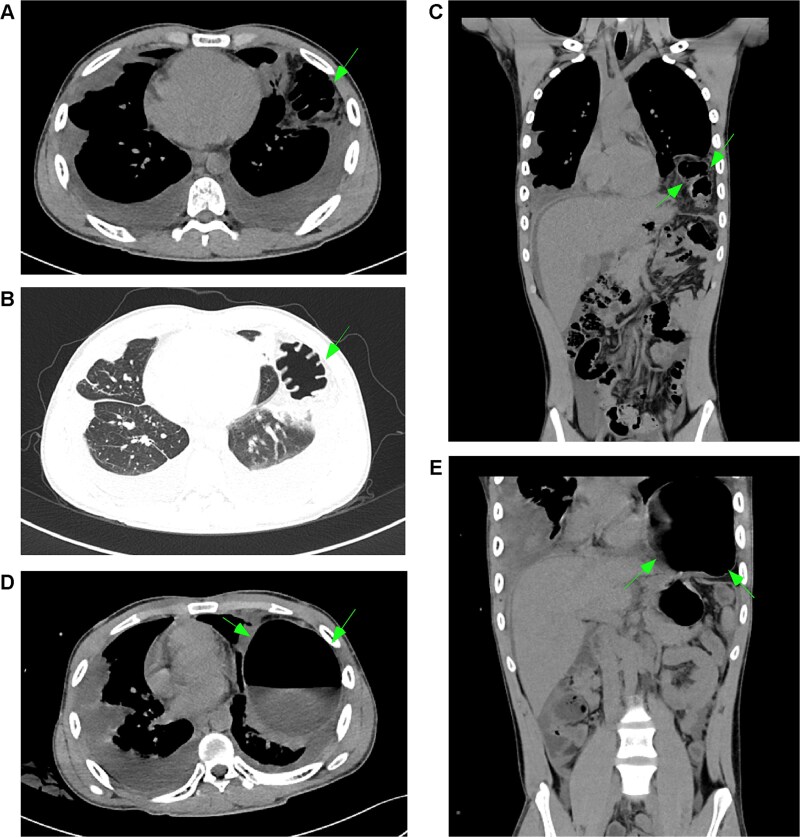 Chylothorax-induced diaphragmatic herniation: a novel complication of Gorham-Stout syndrome.