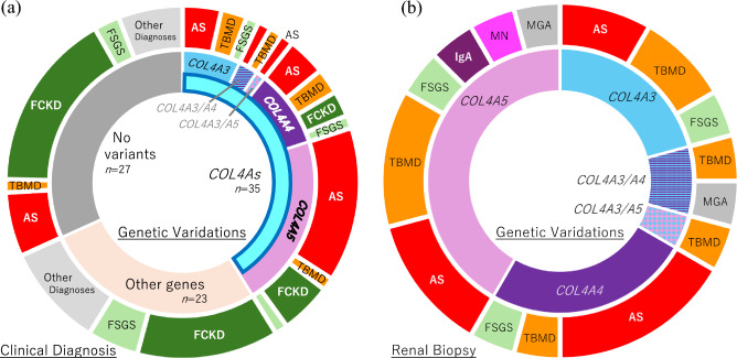 Importance of family history and health checkup for school-aged children for type IV collagen-associated nephropathy in hereditary kidney disease.