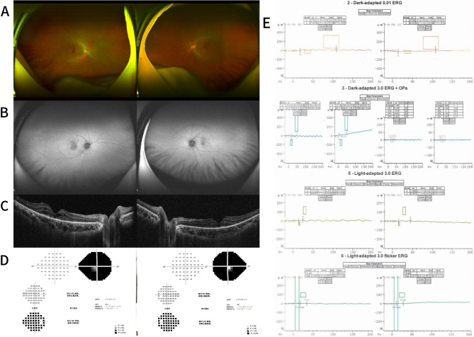 Autoimmune retinopathy in patients with myasthenia gravis: cases series and literature review.