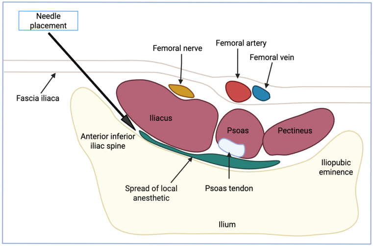 Pericapsular Nerve Group Block Versus Lumbar Epidural Block for Pain Management After Hip Surgeries with a Focus on Pediatric Patients: A Narrative Review.